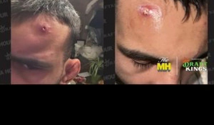 MMA : "Tu ne dis pas ça quand tu perds…" Dustin Poirier charge violemment Benoît Saint-Denis, qui dit avoir été diminué par un staphylocoque